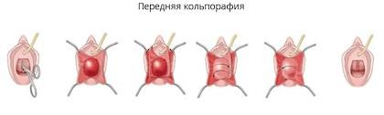 передня кольпорафія операція Київ